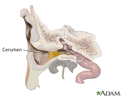 What is Ear Wax ? (Section 1)