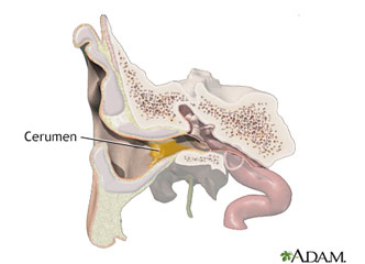 What is Ear Wax ?